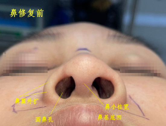 术前鼻翼外扩鼻小柱比较宽鼻孔较圆鼻基底凹陷