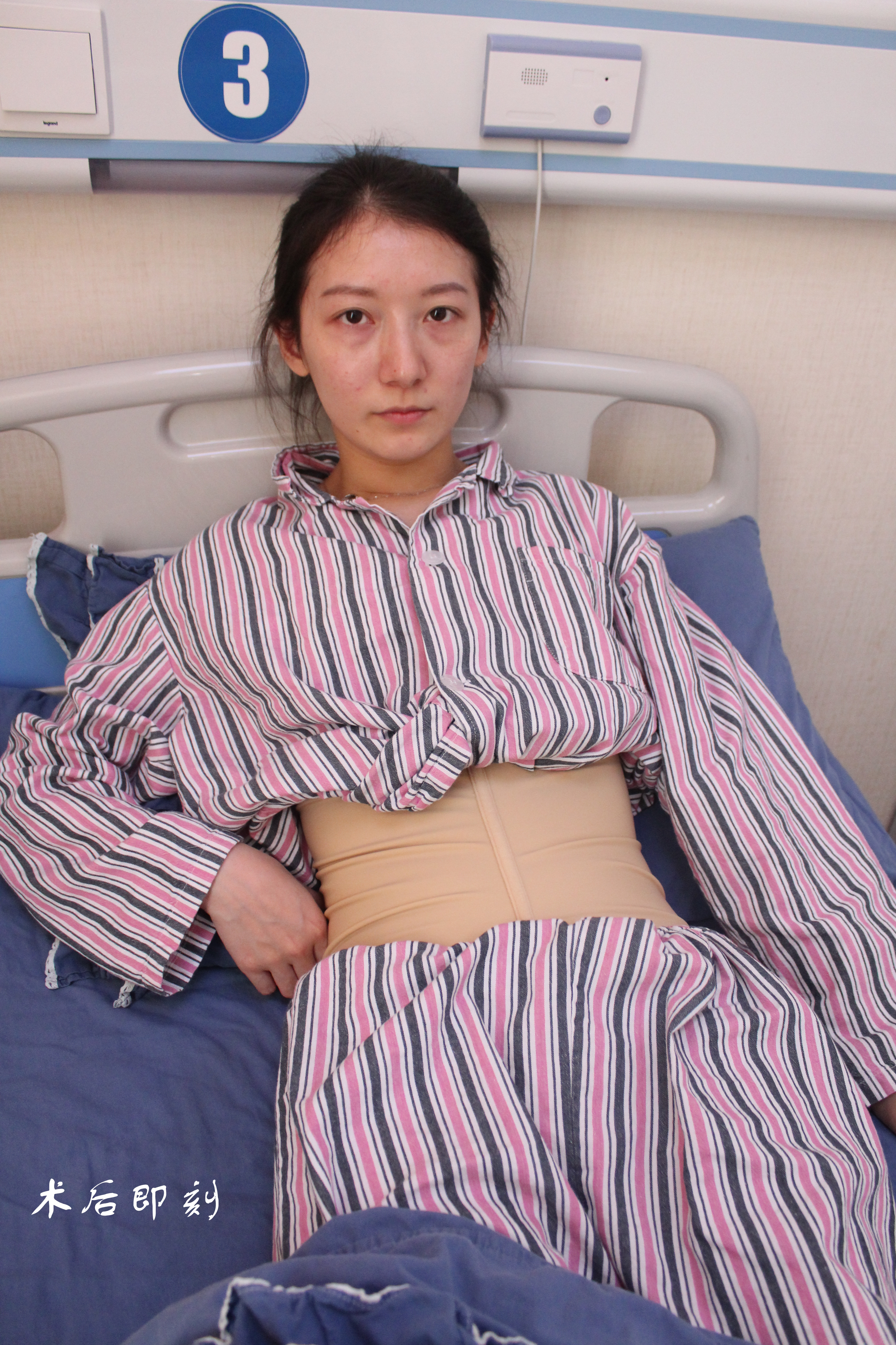 患者28岁,因长期久坐,腰腹肉眼可见赘肉堆积,小腹_圈子-新氧美容整形