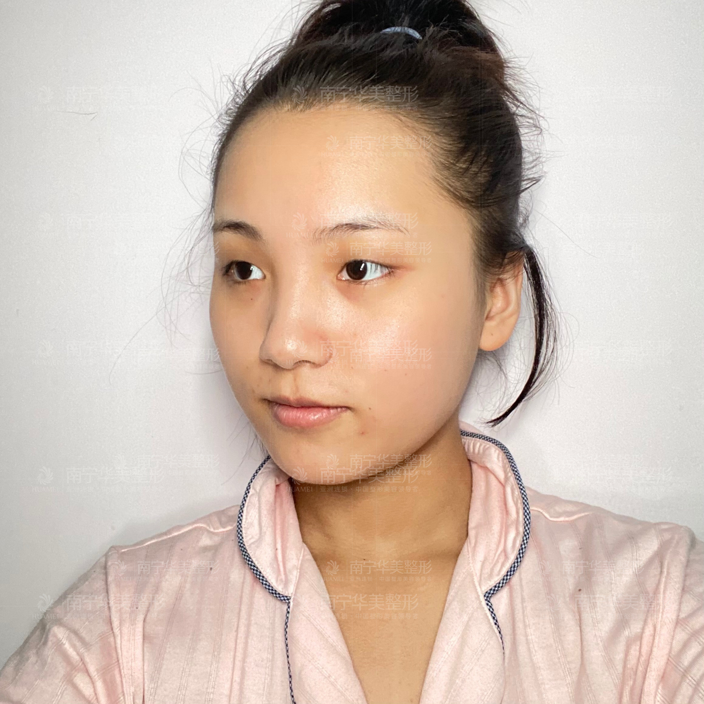 术前单眼皮,上睑脂肪堆积,眼裂较短,眼睛无神,姑娘_圈子-新氧美容整形