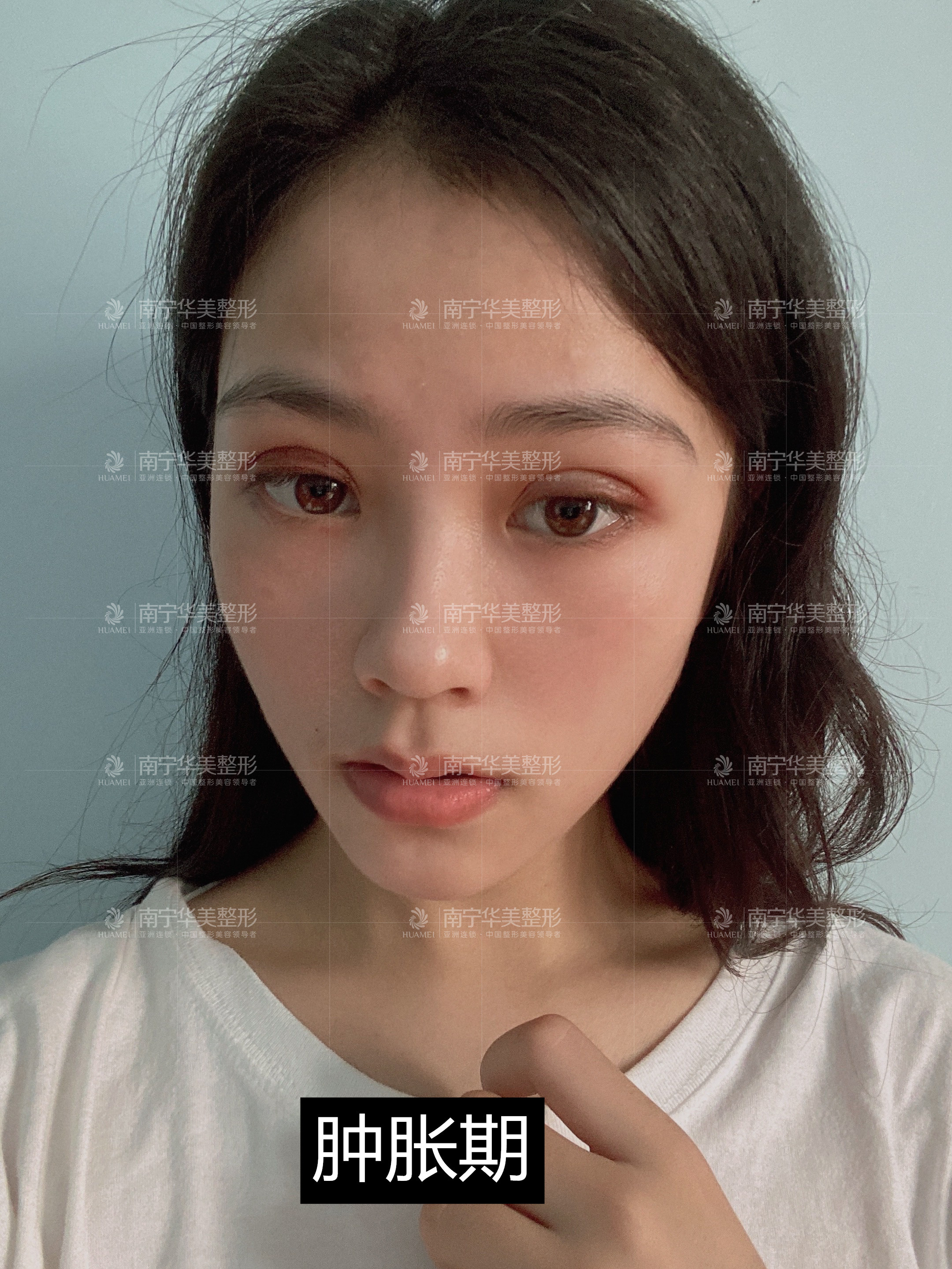 术前诊断这是一个眼皮内双的案例,内眦赘皮,轻度上睑_圈子-新氧美容