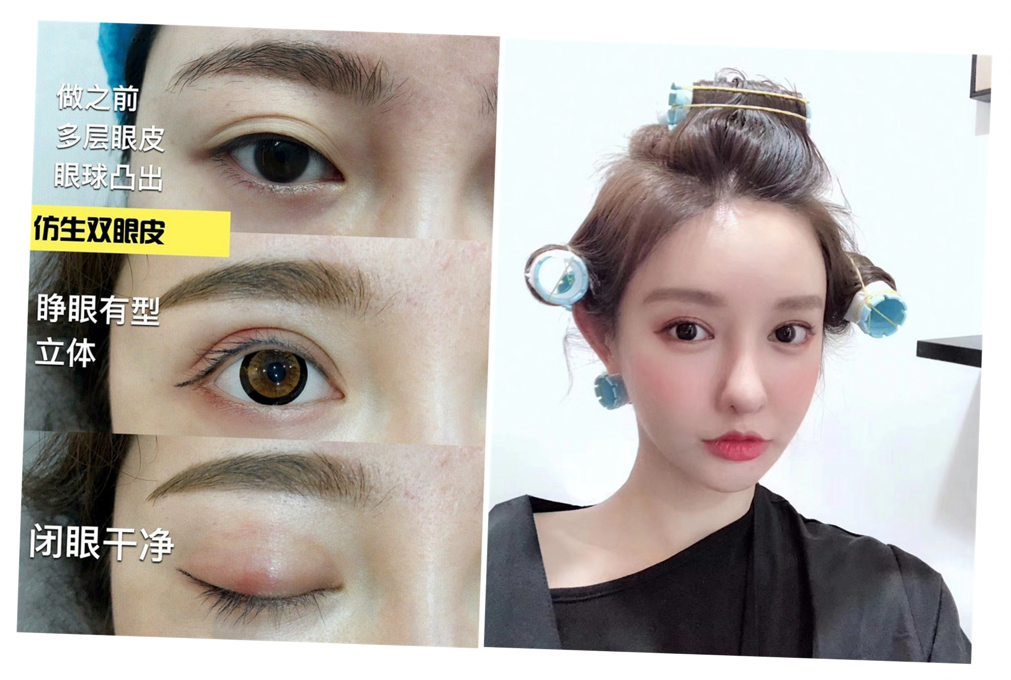于是就打算去做个双眼皮了,主要多层眼皮的情况就很烦人,经过多方咨询