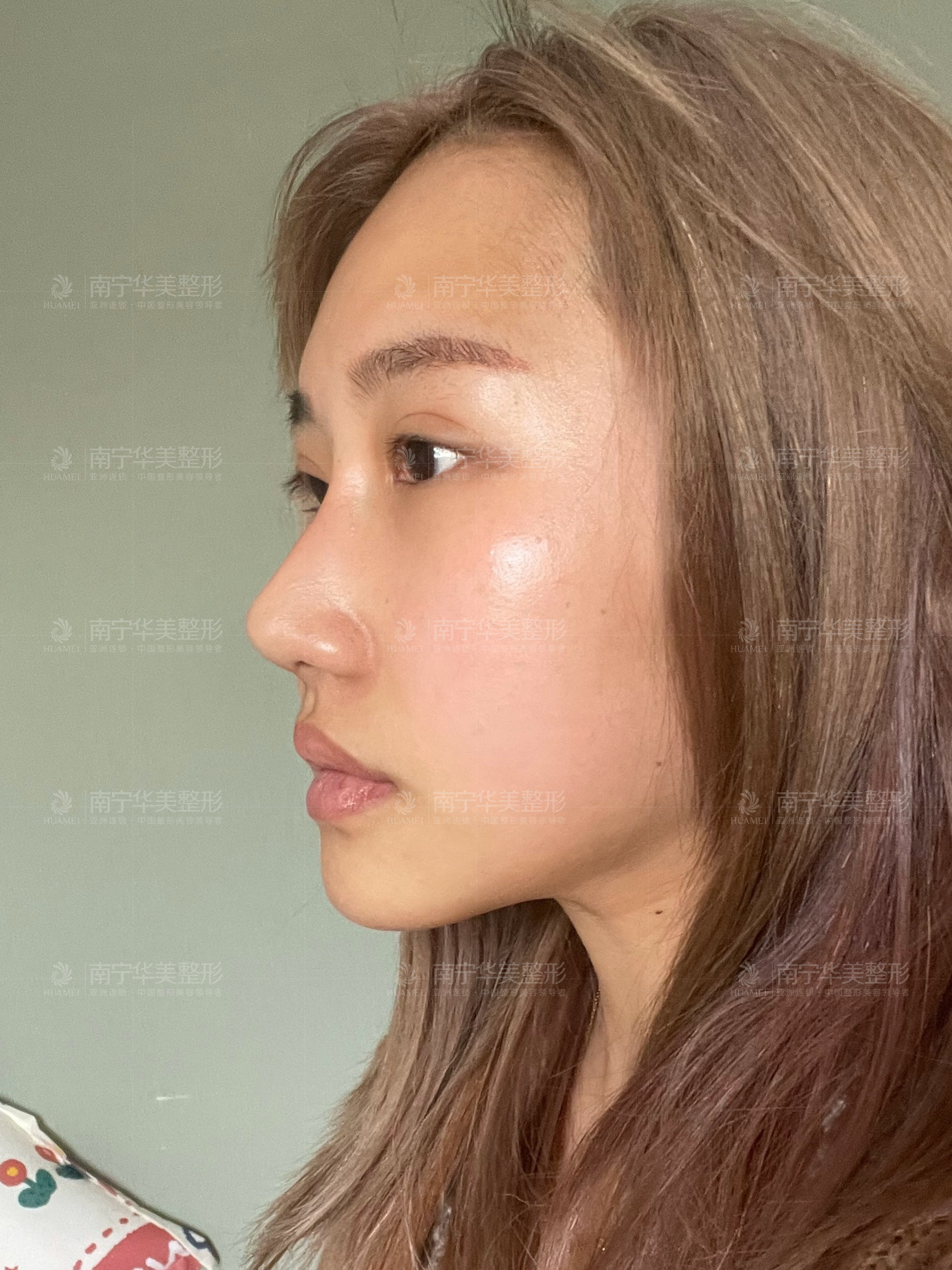 例鼻部修复案例,这个姑娘4年前在外院做过硅胶隆鼻