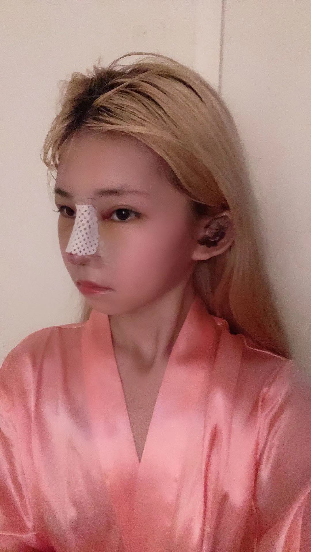 【鼻部多项-舒铂超肋隆鼻术后5天】