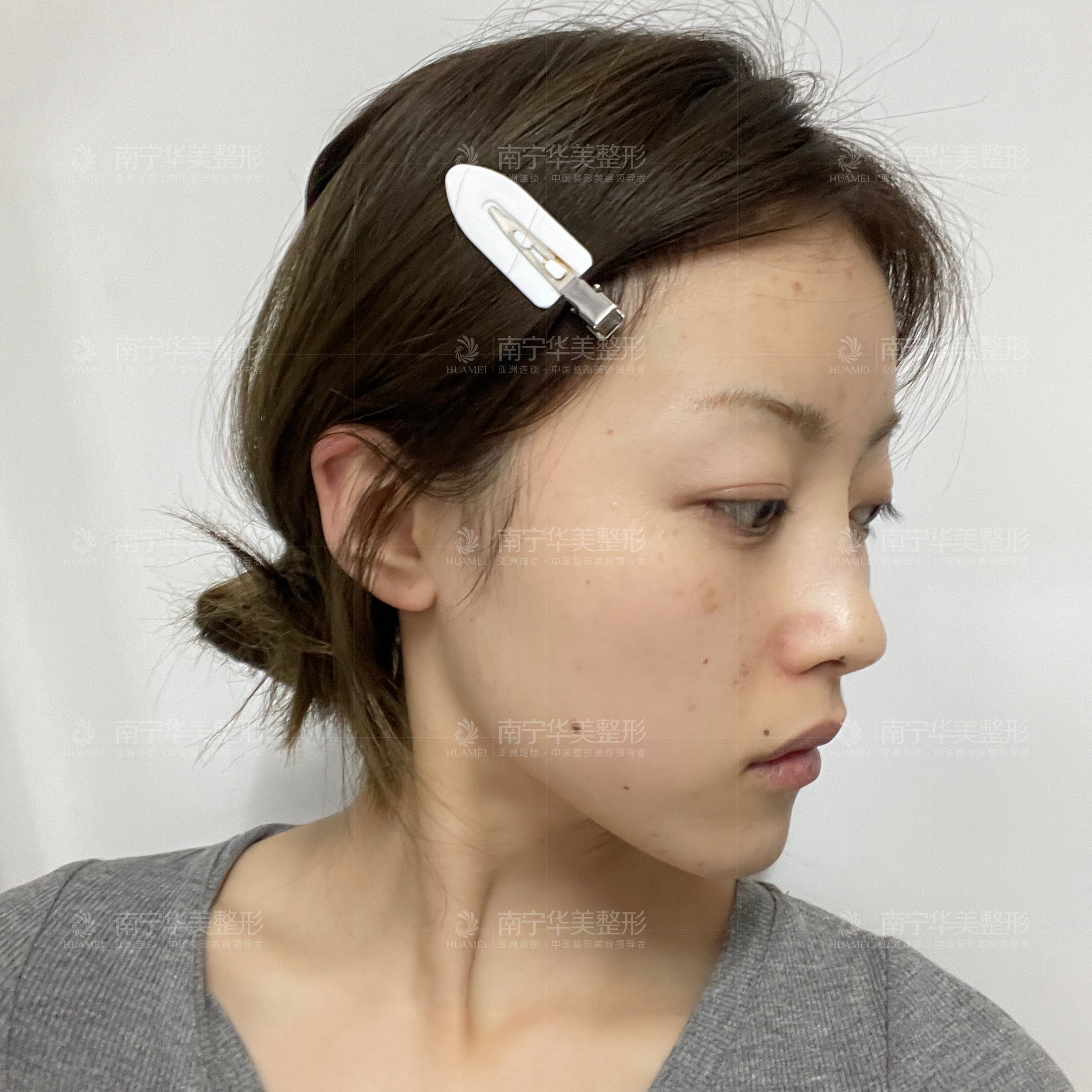 鼻梁低矮,鼻小柱短,鼻尖缺乏表现点,小姑娘长得比较_圈子-新氧美容