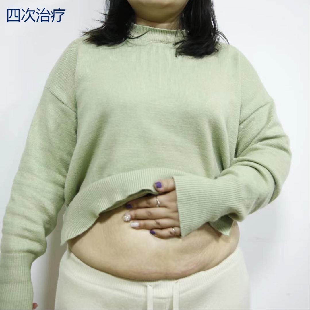 剖腹产是横切好还是竖切?