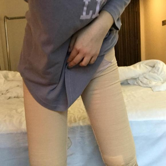 案例欣赏大腿环吸瘦腿针瘦小腿