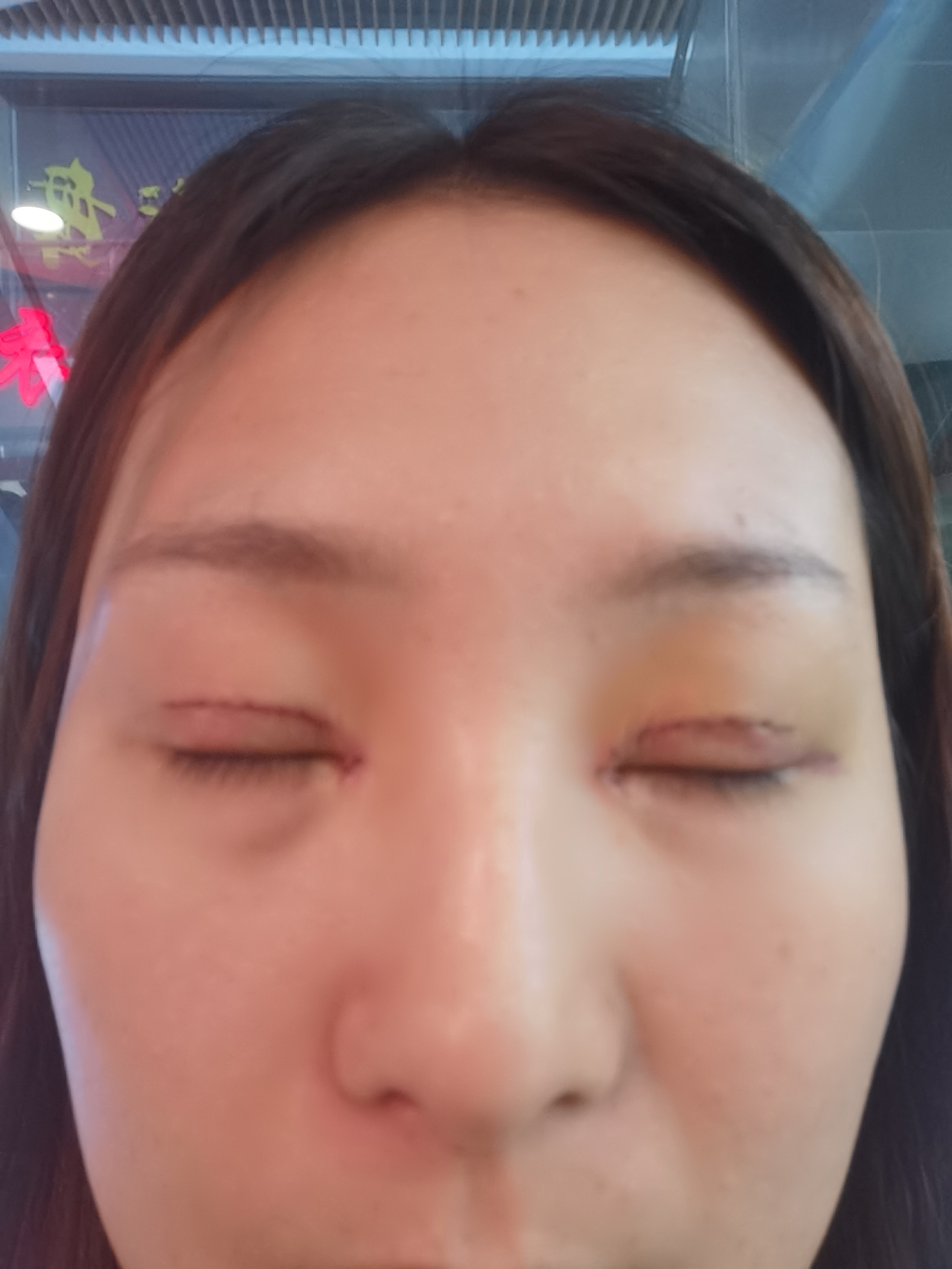 在杭州薇琳做双眼皮手术第3天