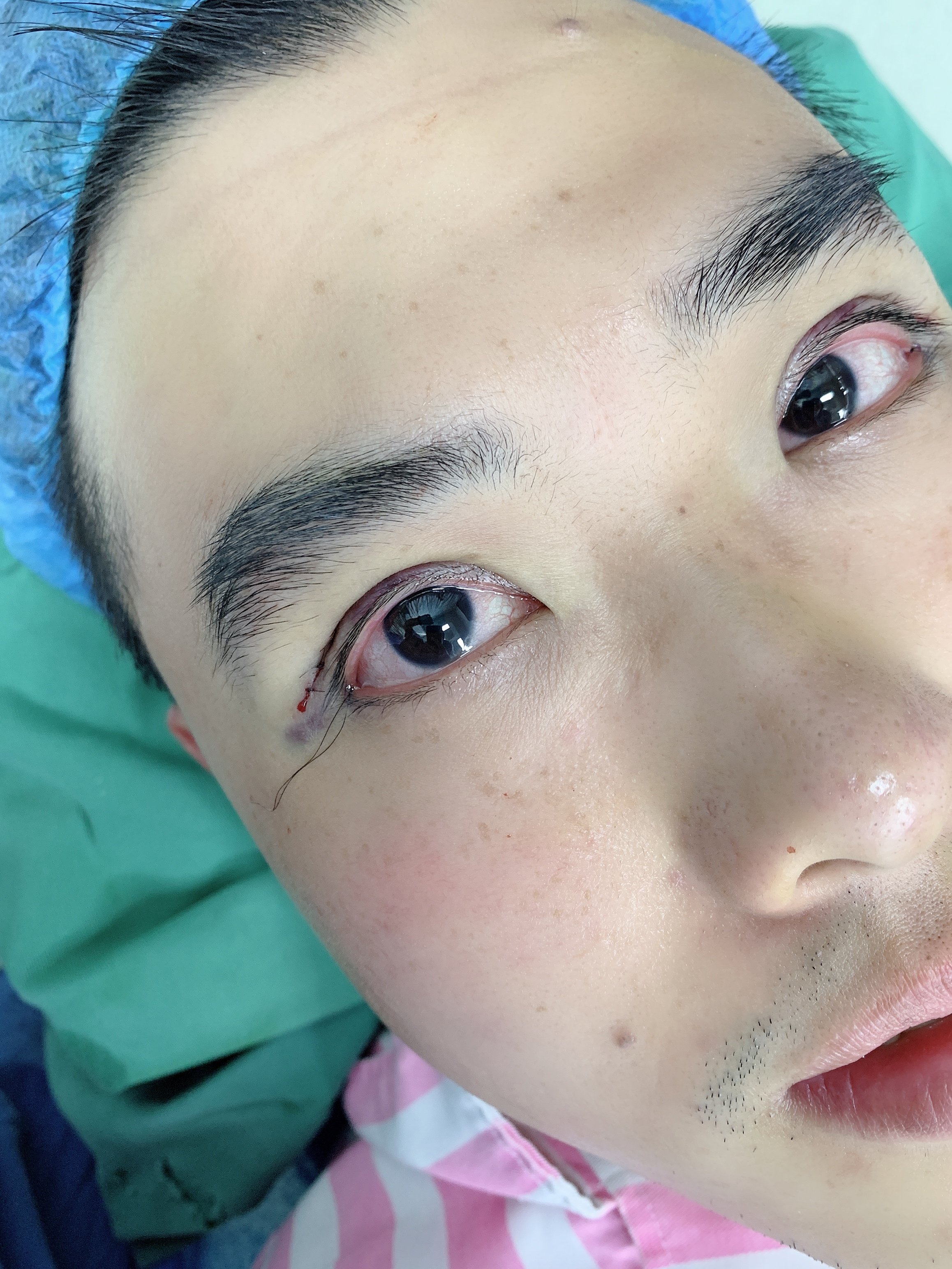 术前眼睛细小狭长眼球曝光度低眼睛小,眼皮松弛耷拉,_圈子-新氧美容