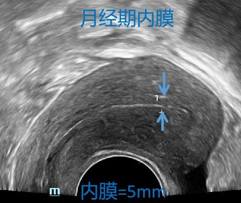 临床上子宫内膜的厚度都是通过b超测量来了解它的厚度