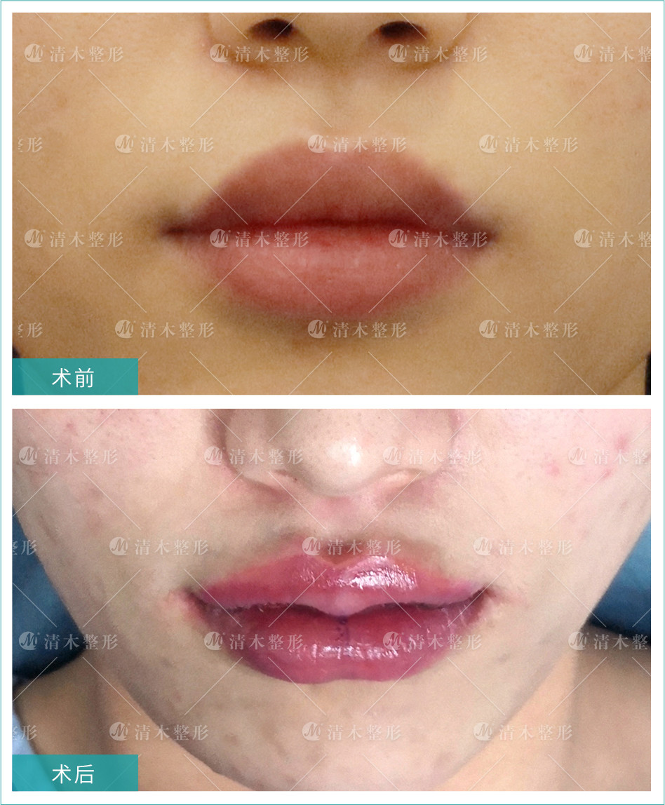 嘴过大 为口的宽度超过美学标准,其手术方