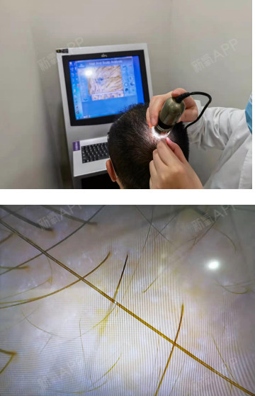 脱发头屑多头皮出油做毛囊检测才知道问题出在哪