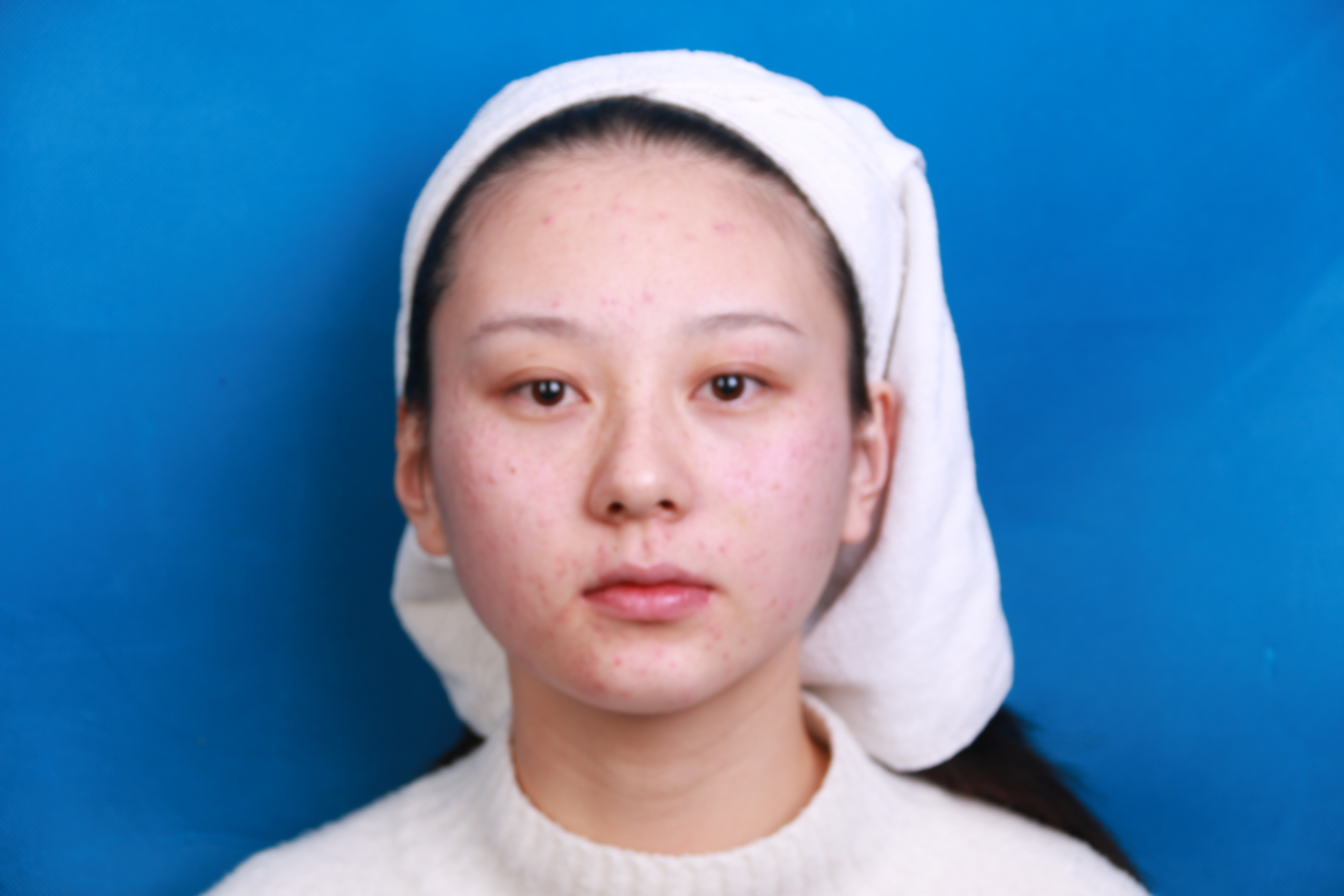 皮秒祛斑,雀斑女孩快来集合啦!