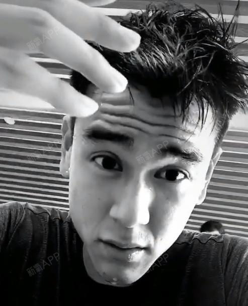 有了川字纹到底是打肉毒素还是玻尿酸