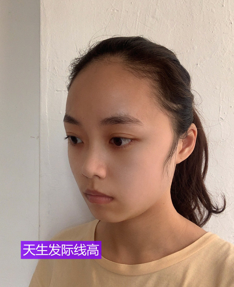 天生发际线高的有吗?