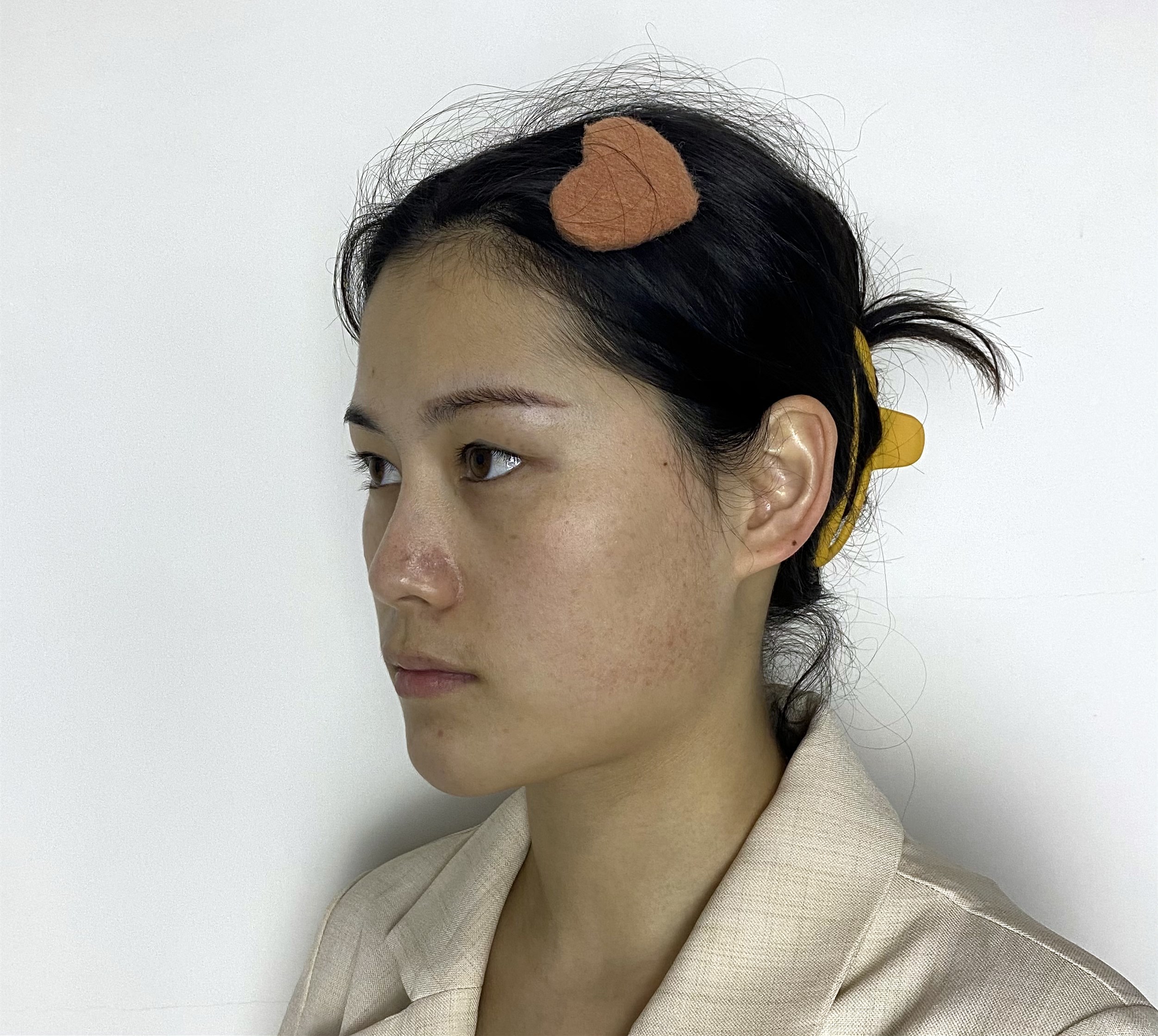 【术后第一天--达拉斯隆鼻】