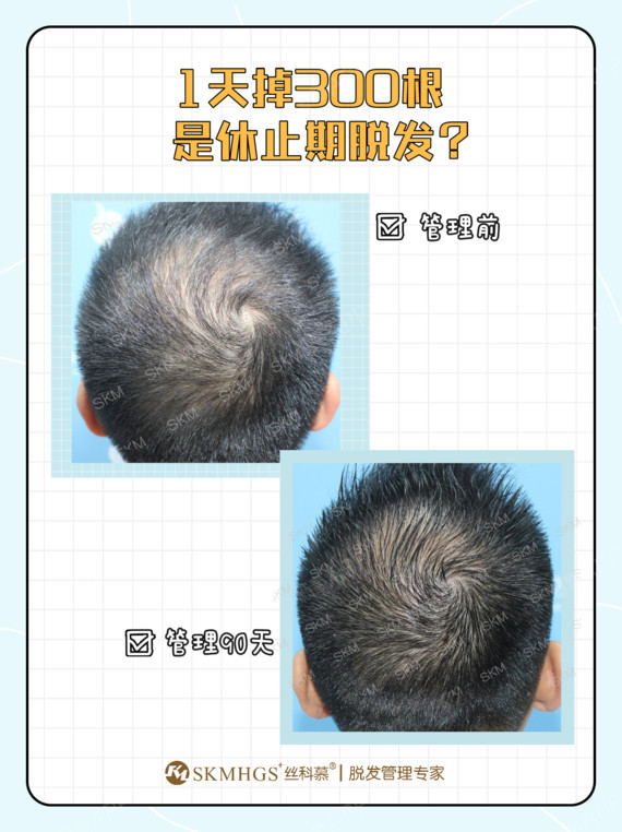 [:66]休止期脱发,指各种因素干扰了毛囊生长周期