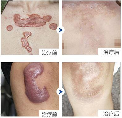 点阵激光祛疤效果好吗