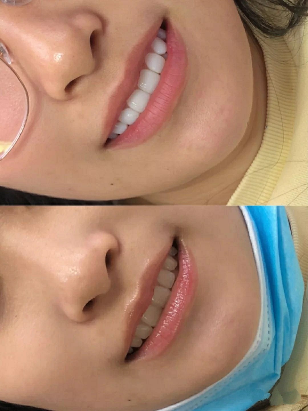 被戚薇种草到去做了全瓷牙贴面