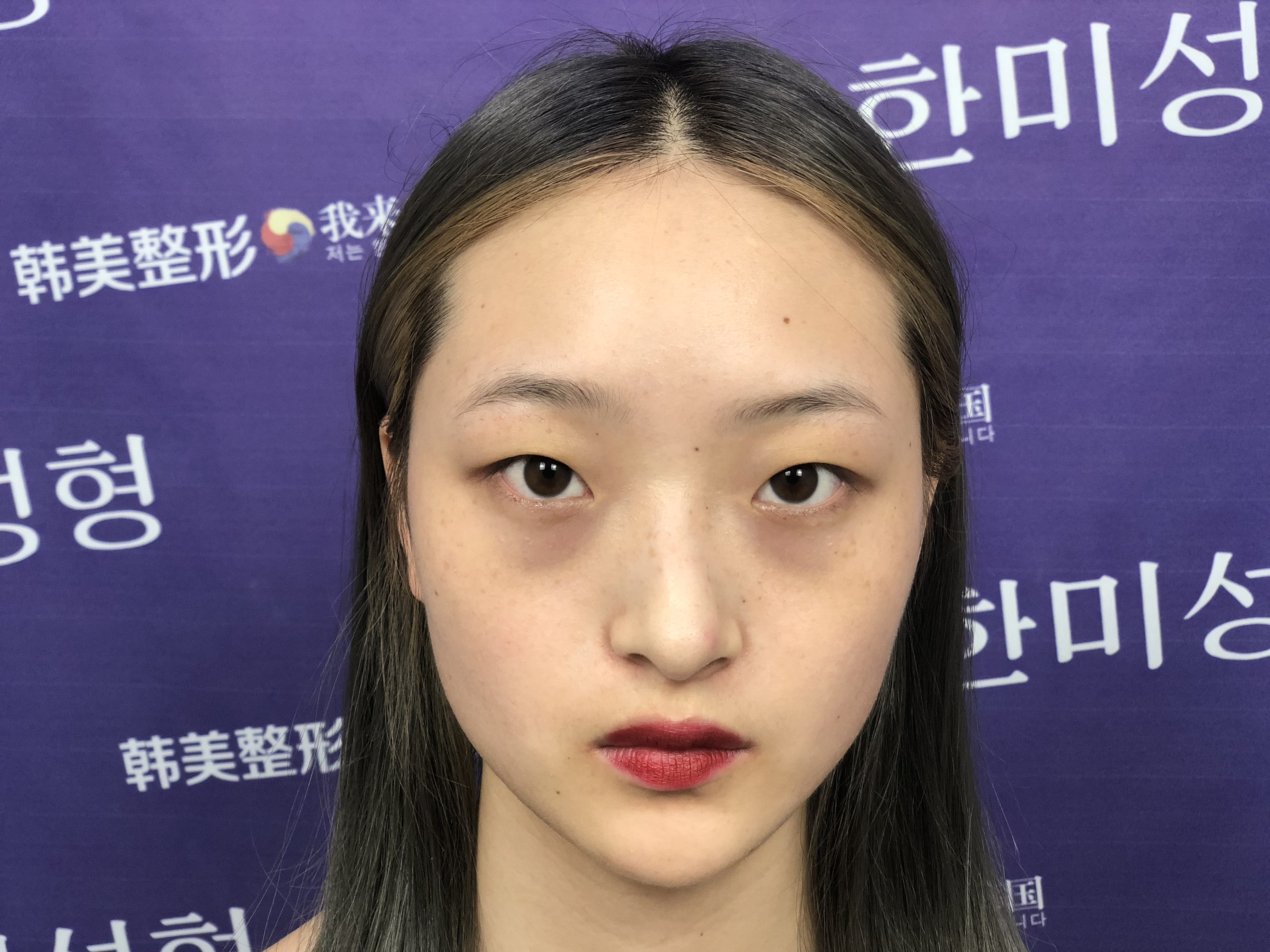 单眼皮 眼无神切开双眼皮 开内眼角 大多数人认_圈子-新氧美容整形