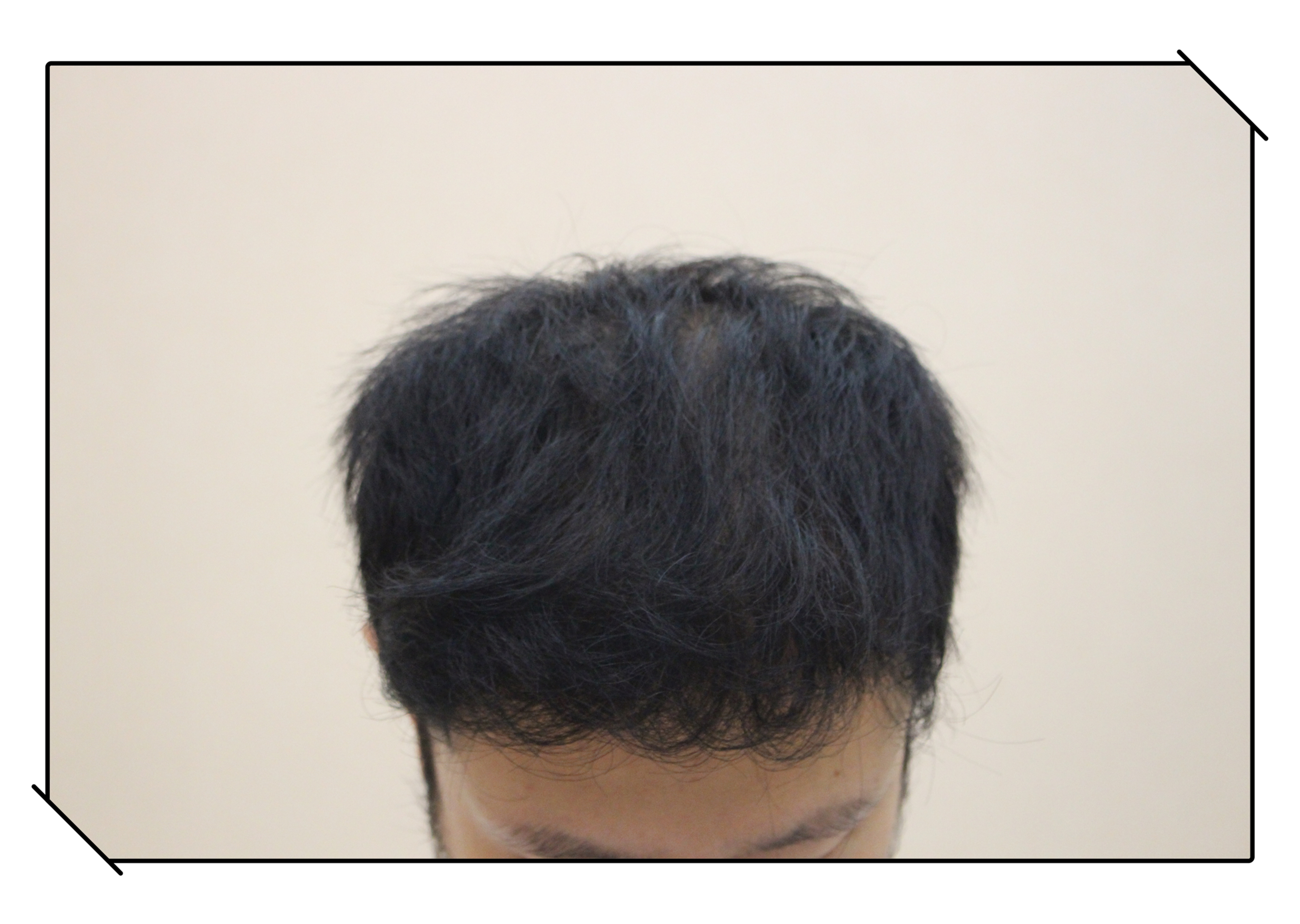 头发变白是因为毛囊里面_圈子-新氧美容整形