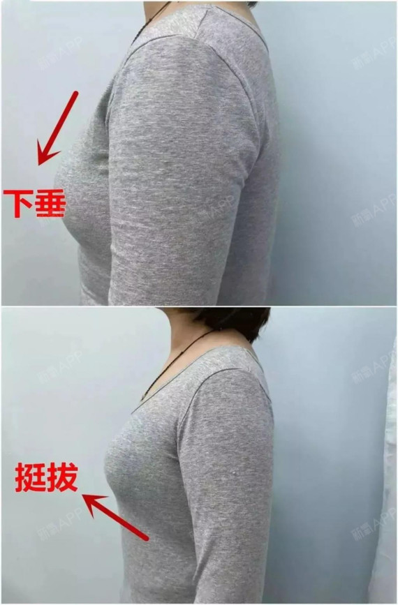 胸假性下垂图片