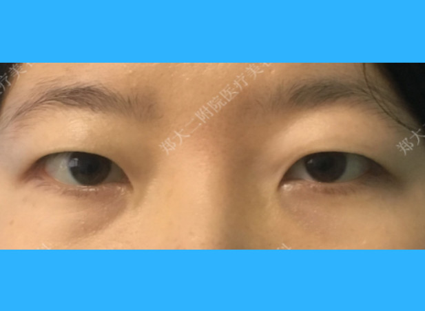 眼部脂肪比较多状态不佳