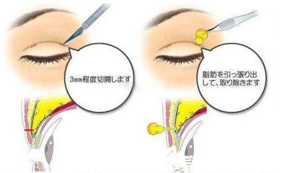 眶隔脂肪释放手术是怎么同时解决肿泡眼和大眼袋问题的
