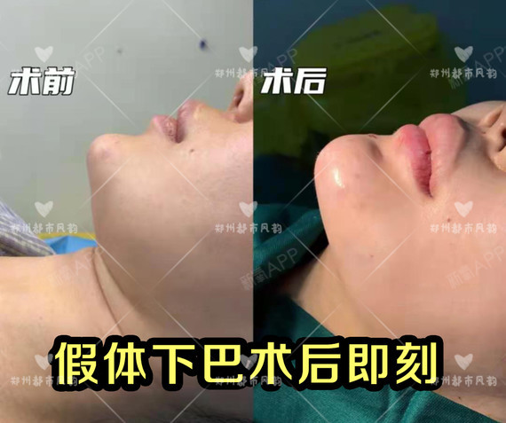 膨体垫下巴会显假不够真实吗?有哪些优势呢?