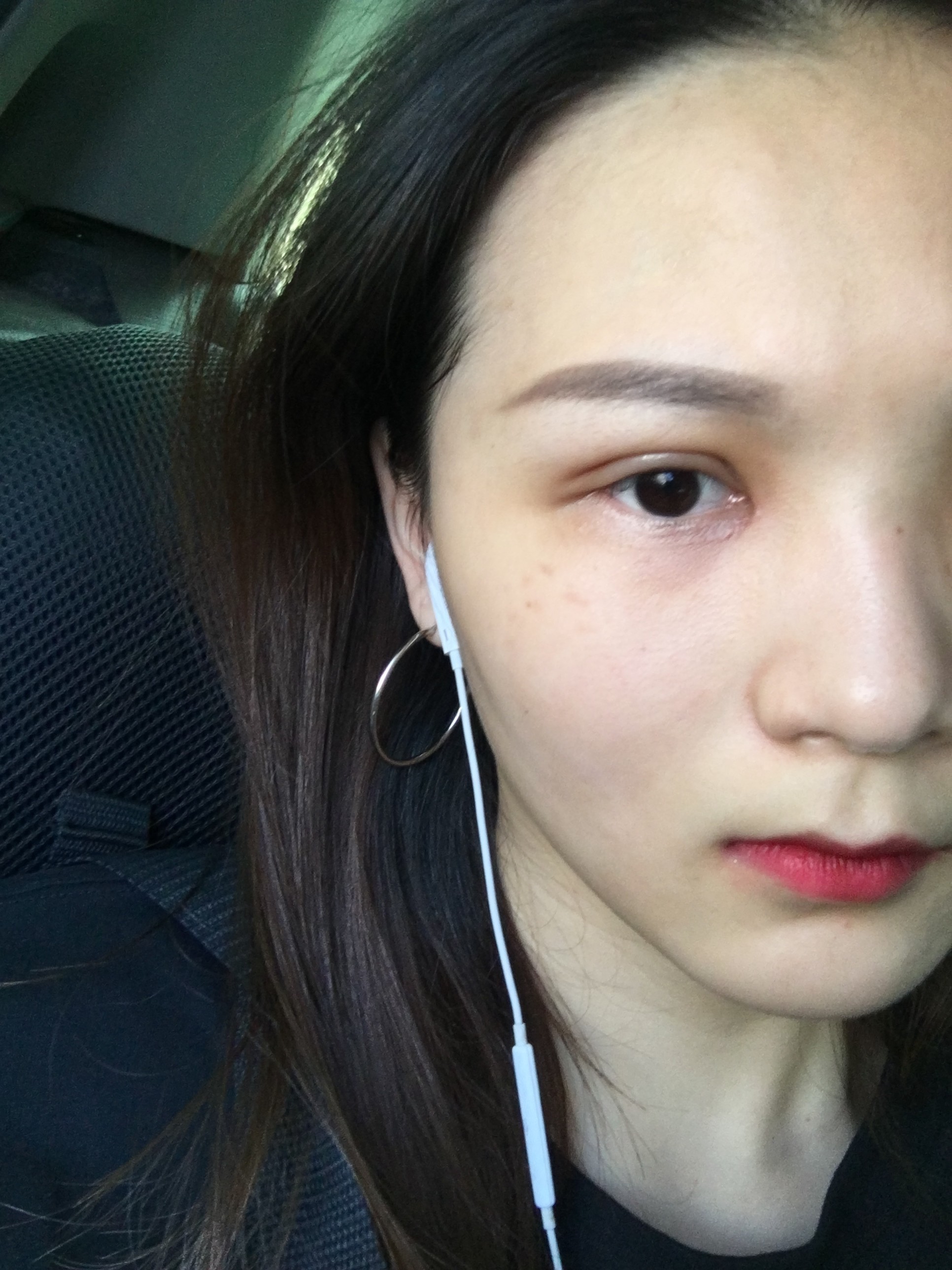 术前单眼皮内眦赘皮上脸下垂无神