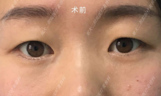 术前单眼皮内眦赘皮眼睛有些下垂