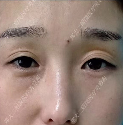 术前重睑凹陷,眼角下垂,显老没气质