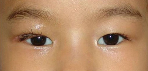 儿童上睑下垂,不但不美观,还可能影响视力,可以尽快手术矫正,避免发生