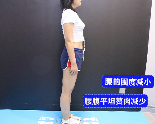 妈妈臀腰腹吸脂案例分享#性价比最高的医美项目术前