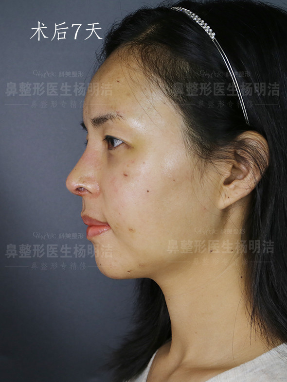 小姐姐术前鼻翼缘发育不良露鼻孔,鼻尖下旋有点鹰钩鼻_圈子-新氧美容