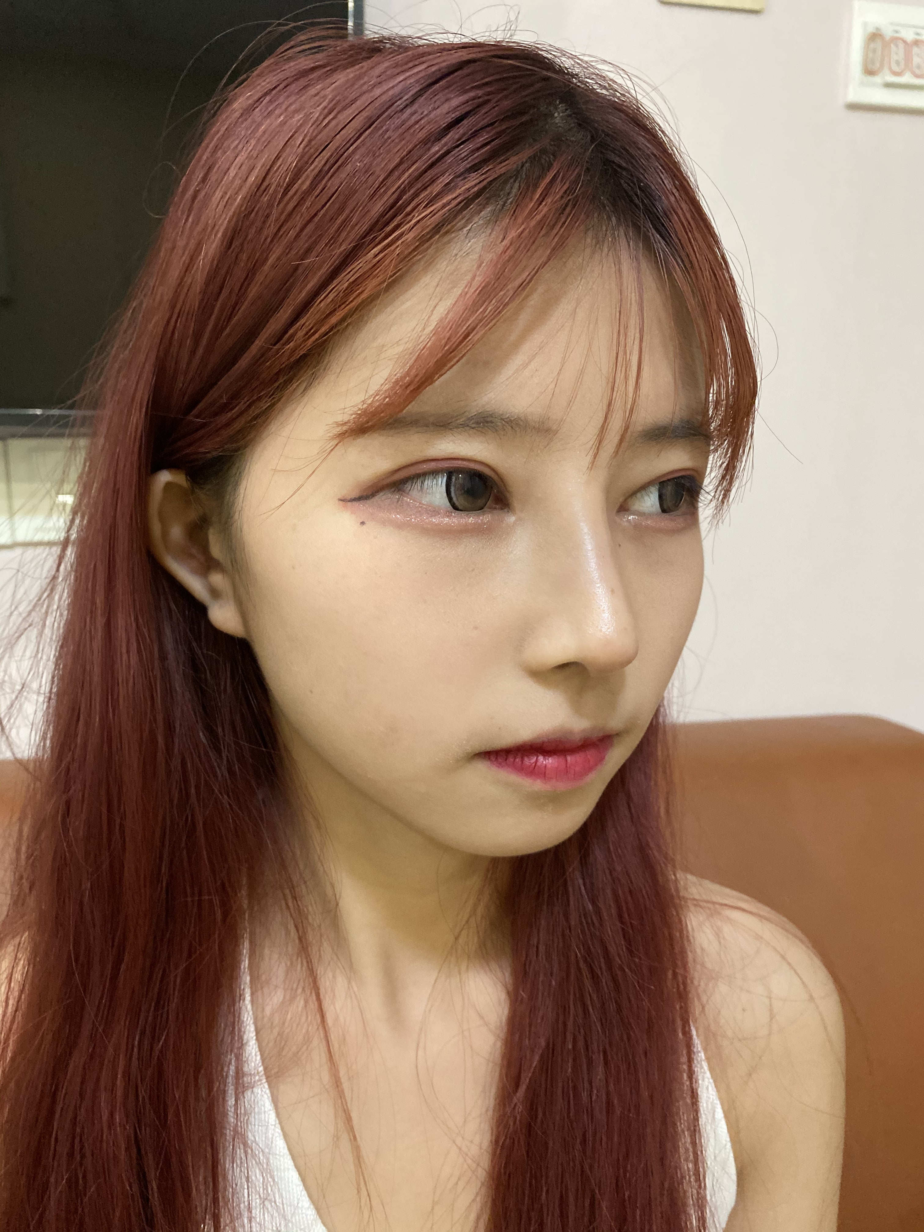 鼻部多项舒铂超肋隆鼻术后一个多月