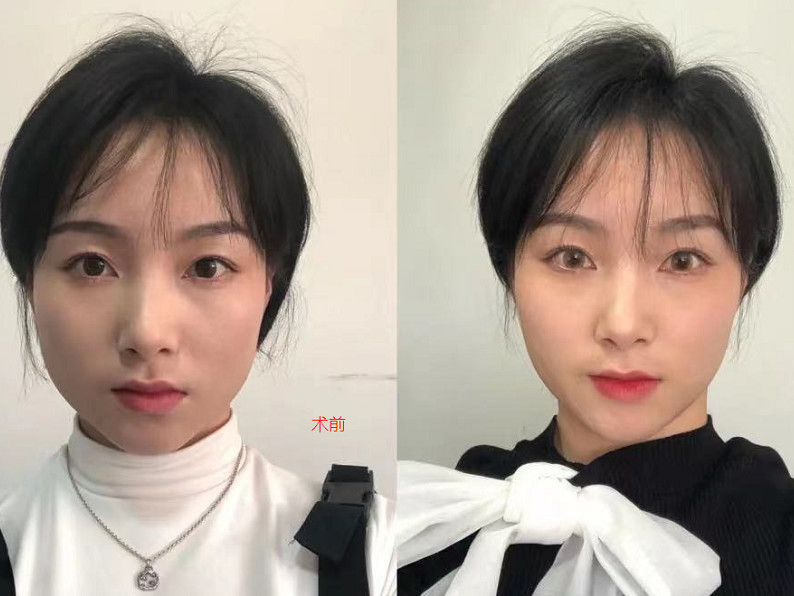 国产衡力瘦脸针,瘦_圈子-新氧美容整形