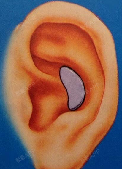 耳软骨隆鼻67想成为男神女神_圈子-新氧美容整形