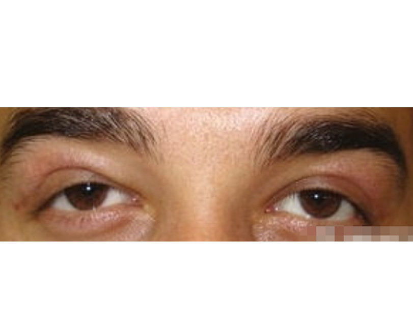 术前泪腺脱垂的眼睛,皮肤像帘子样下垂,眼皮臃肿明显_圈子-新氧美容