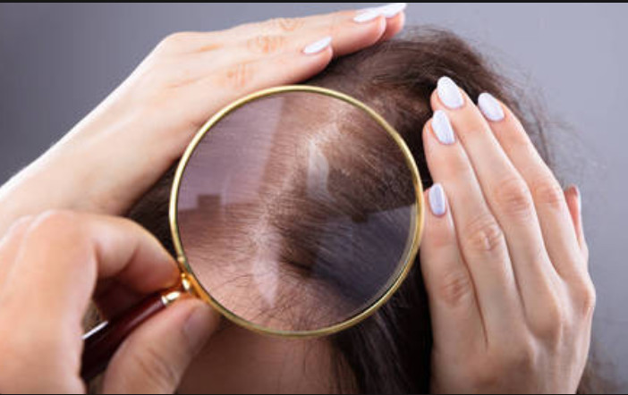 发际线变宽该怎么办71面对越来越宽的发际线该怎么办呢_圈子-新氧