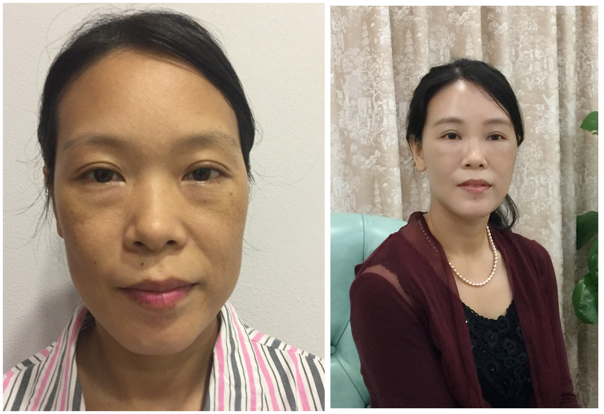 张建强全脸脂肪填充案例】【术前诊断】:额颞部凹_圈子-新氧美容整形