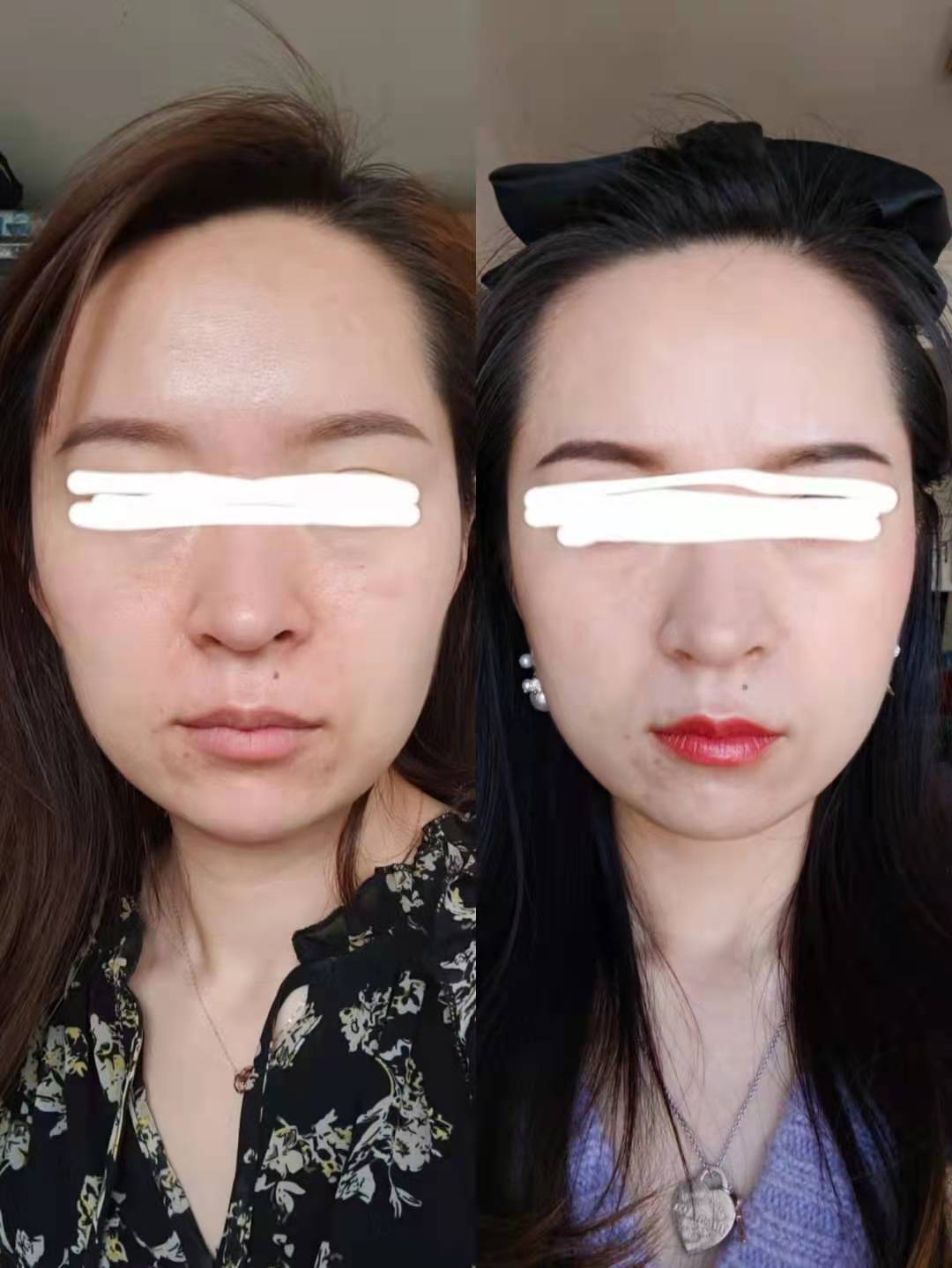 热玛吉的对比效果!