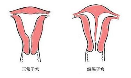 "或者还有很多患者根本不了解什么是子宫纵膈,直到孕育困难时才得知.