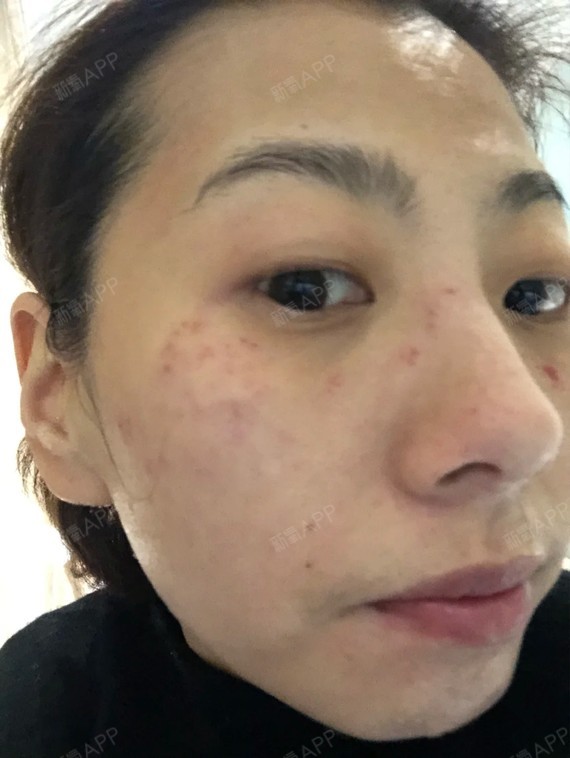 治疗项目:主任给我推荐的是调q激光祛斑的这个方案,_圈子-新氧美容