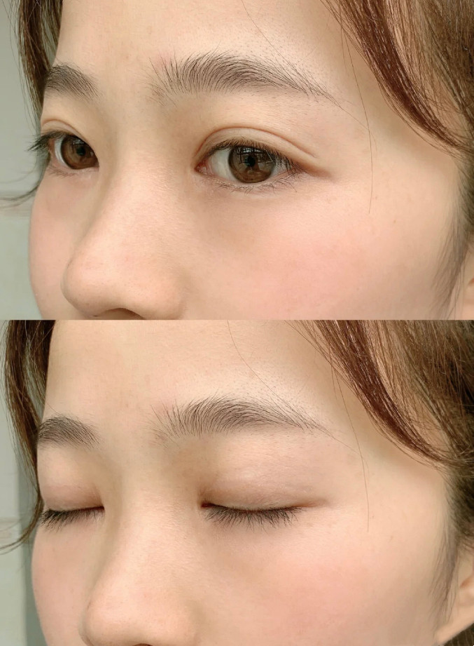 去年12月做的全切双眼皮加开眼_圈子-新氧美容整形