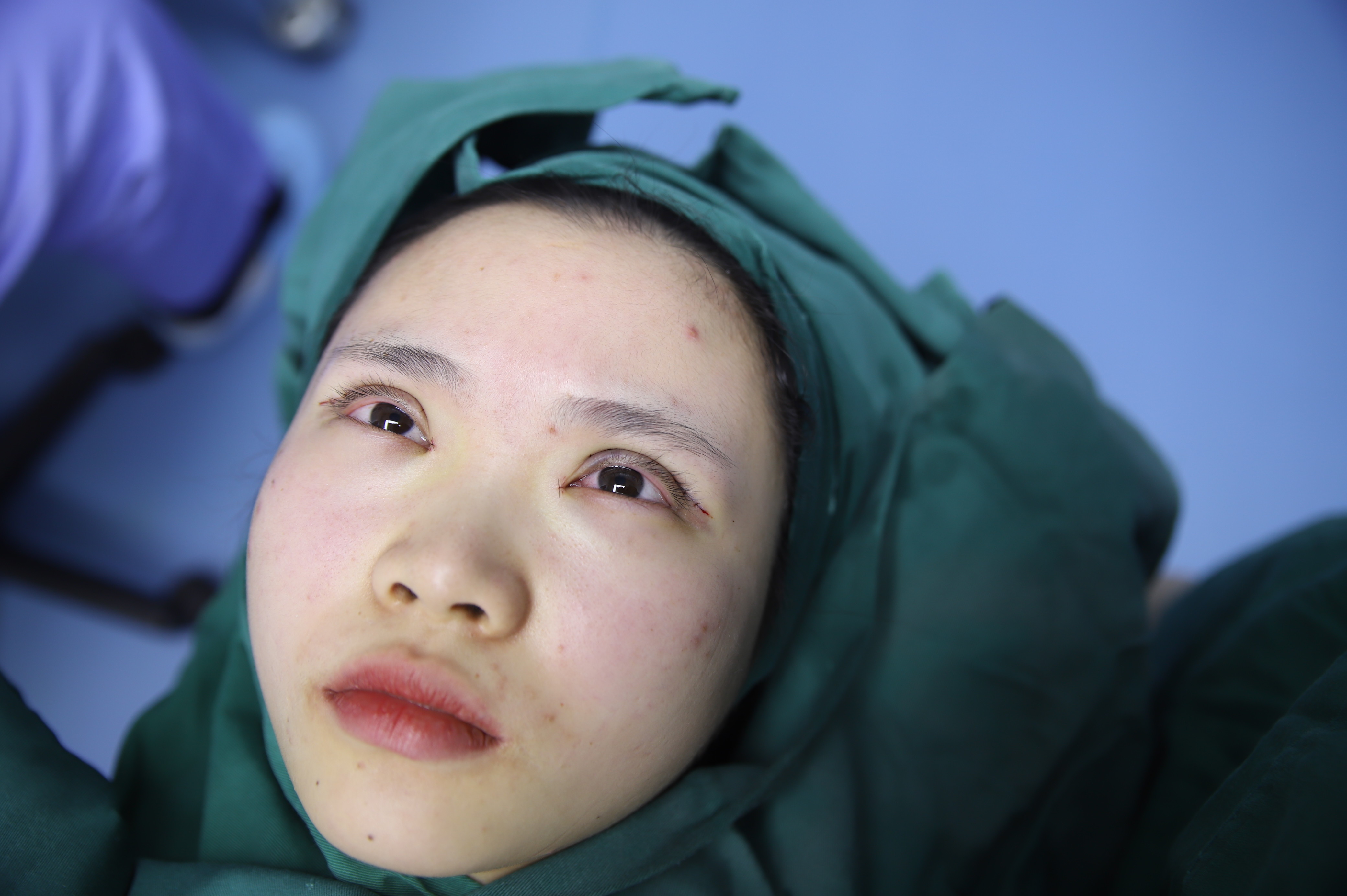 顾客术前:单眼皮,需要开一点眼角.