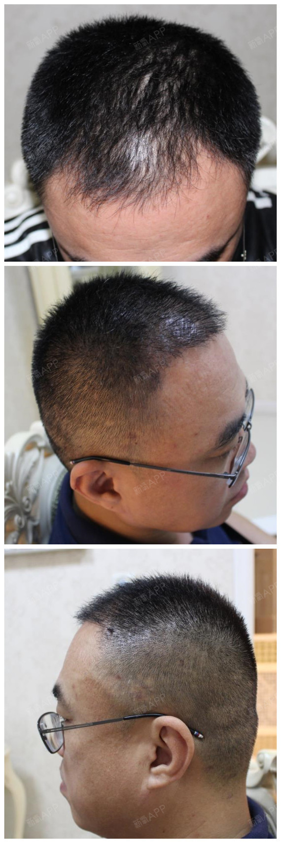 头发种植4个月左右的恢复情况,能看到种植的头发都长