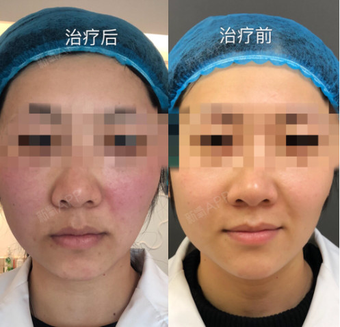 欧洲之星fotona4d的4个步骤效果好吗