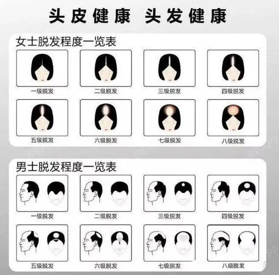 脱发等级对照表看看你脱到几级了
