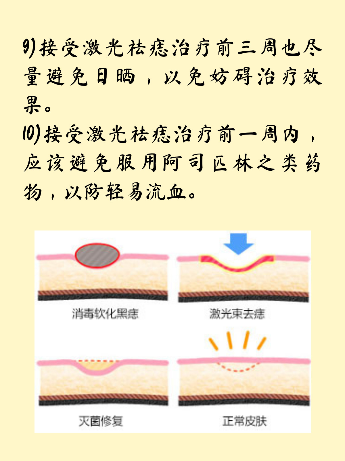 你知道激光祛痣术么激光点痣方法原理是激光仪产生一束