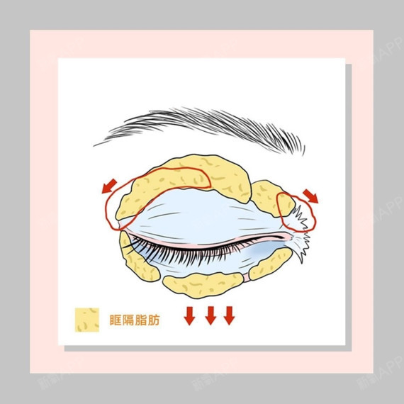 上睑眶隔脂肪多造成的肿眼泡可以,通过全切双眼皮,术前眼部吸脂解决肿